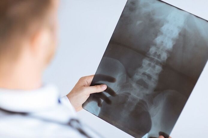 Diagnostične možnosti za ledveno osteohondrozo
