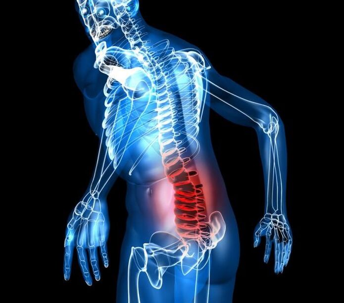 stopnje in razvojne faze ledvene osteohondroze