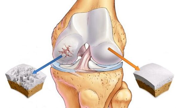 Osteoartritis kolenskega sklepa (levo) in normalnega hrustanca (desno)
